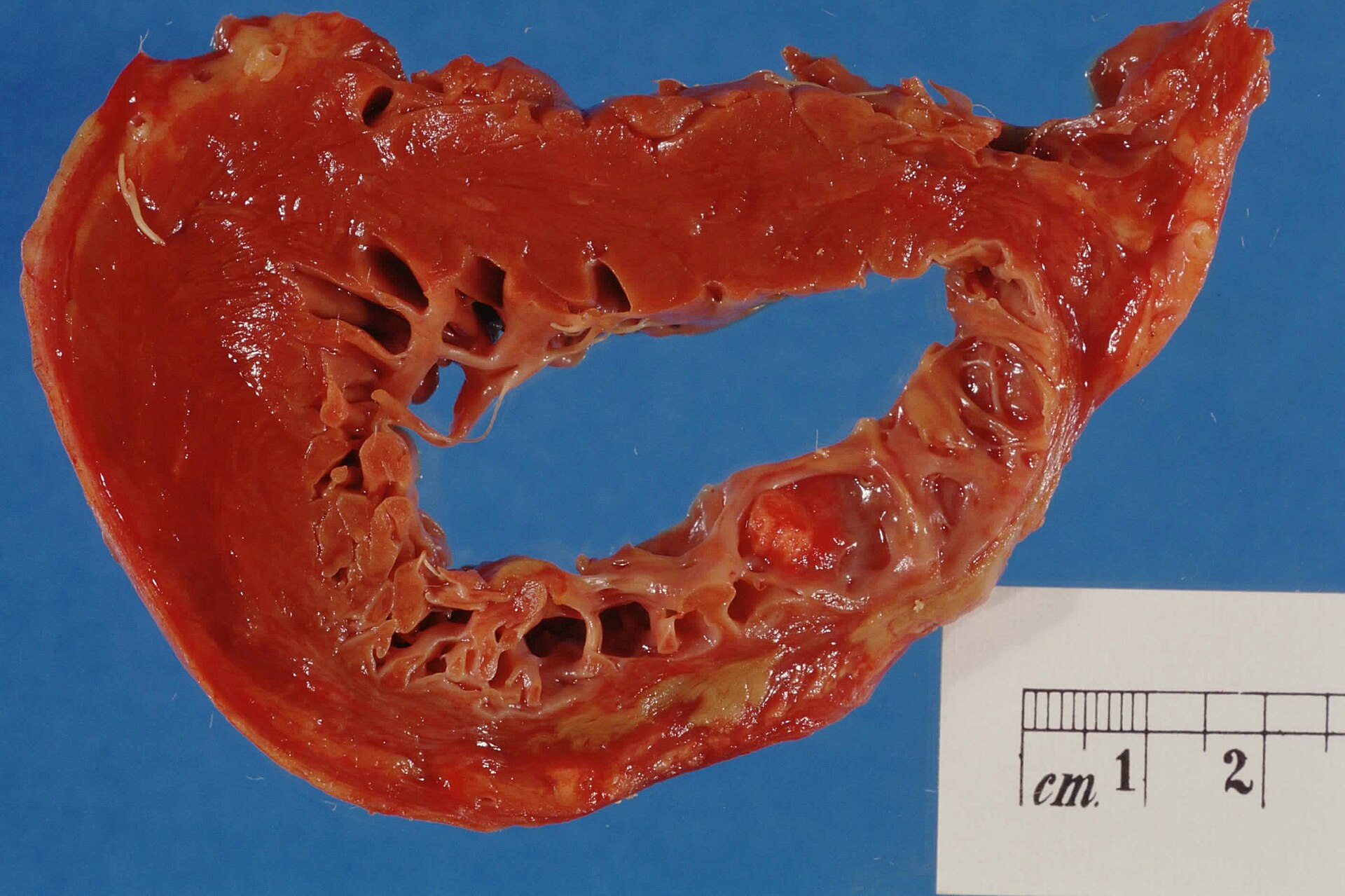 Imagem de referência de cardiopatia, descrito nos dados abertos como o quem que causa doença do coração