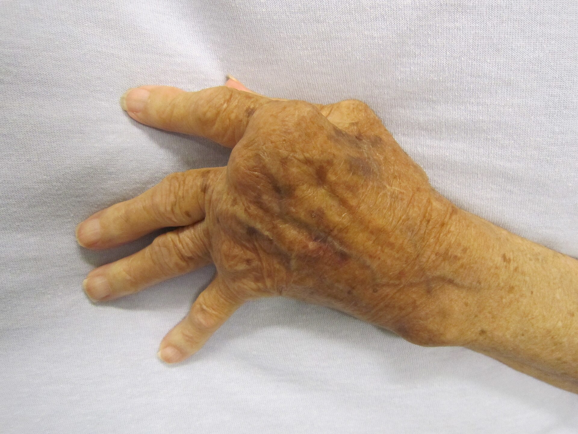 Imagem de referência de artrite reumatoide, descrito nos dados abertos como doença autoimune