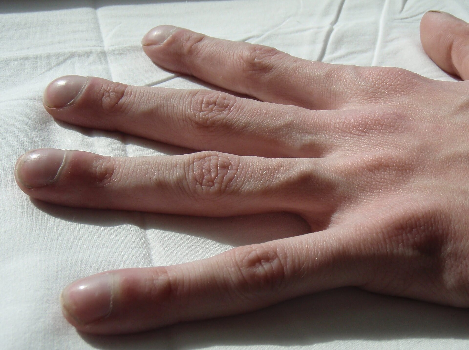 Imagem de referência de fibrose cística, descrito nos dados abertos como doença genética que afeta principalmente os pulmões