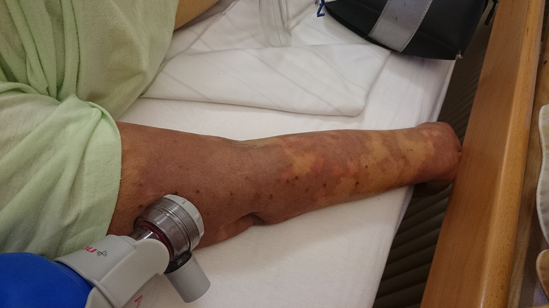 Imagem de referência de sepse, descrito nos dados abertos como resposta inflamatória fatal do corpo contra uma enfermidade