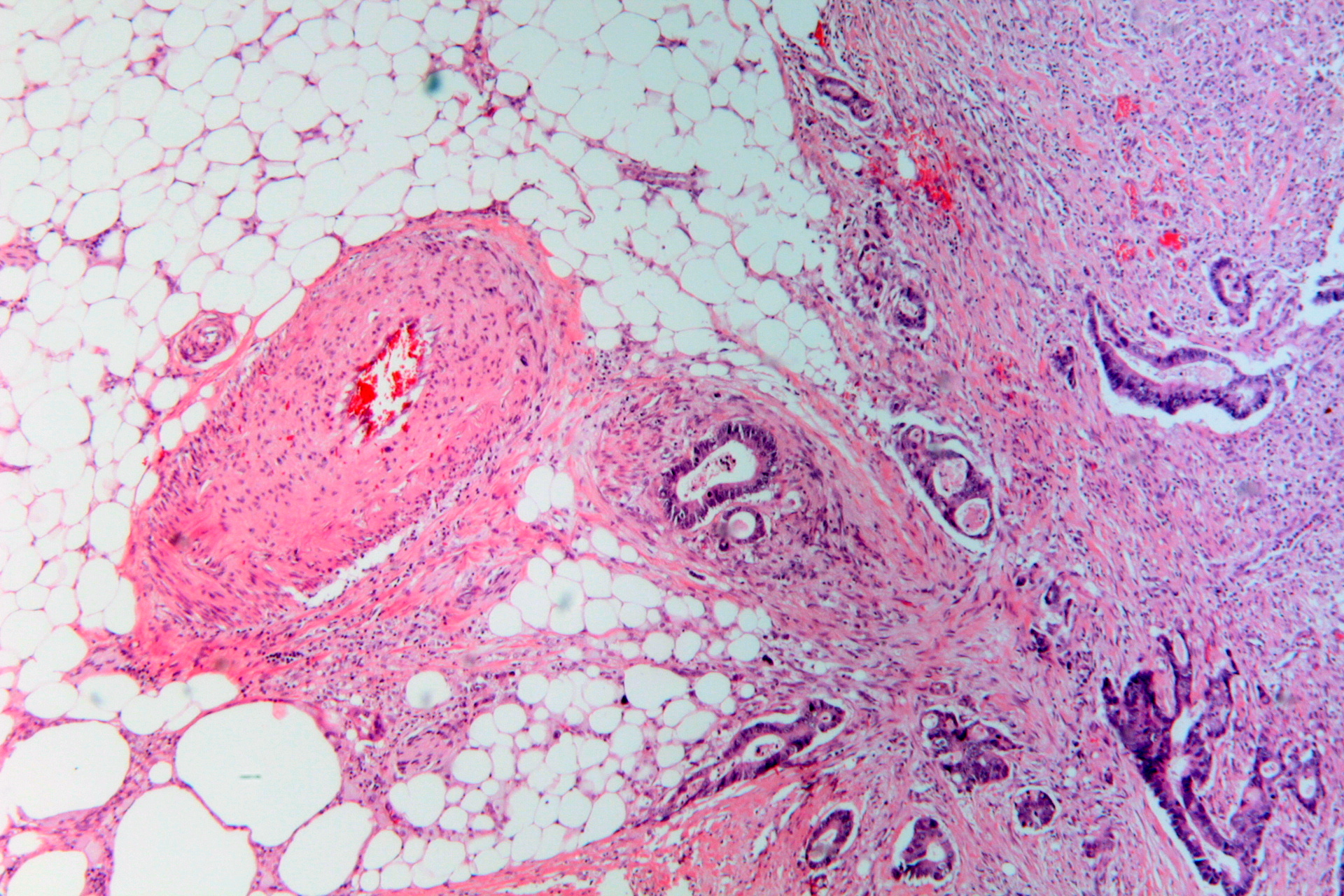 Imagem de referência de cancro colorretal, descrito nos dados abertos como tipo de cancro que surge nas porções do cólon ou reto do intestino grosso