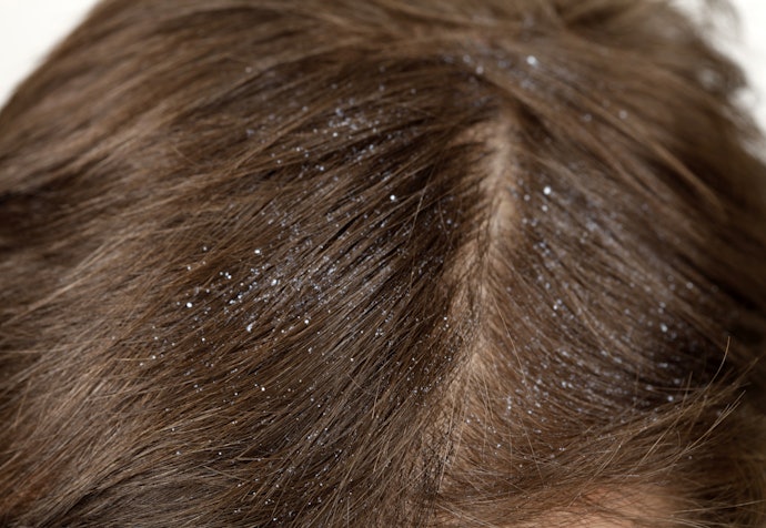 Como Tirar Caspa do Cabelo?